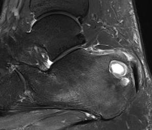 Calcaneal Bony Lesion MRI